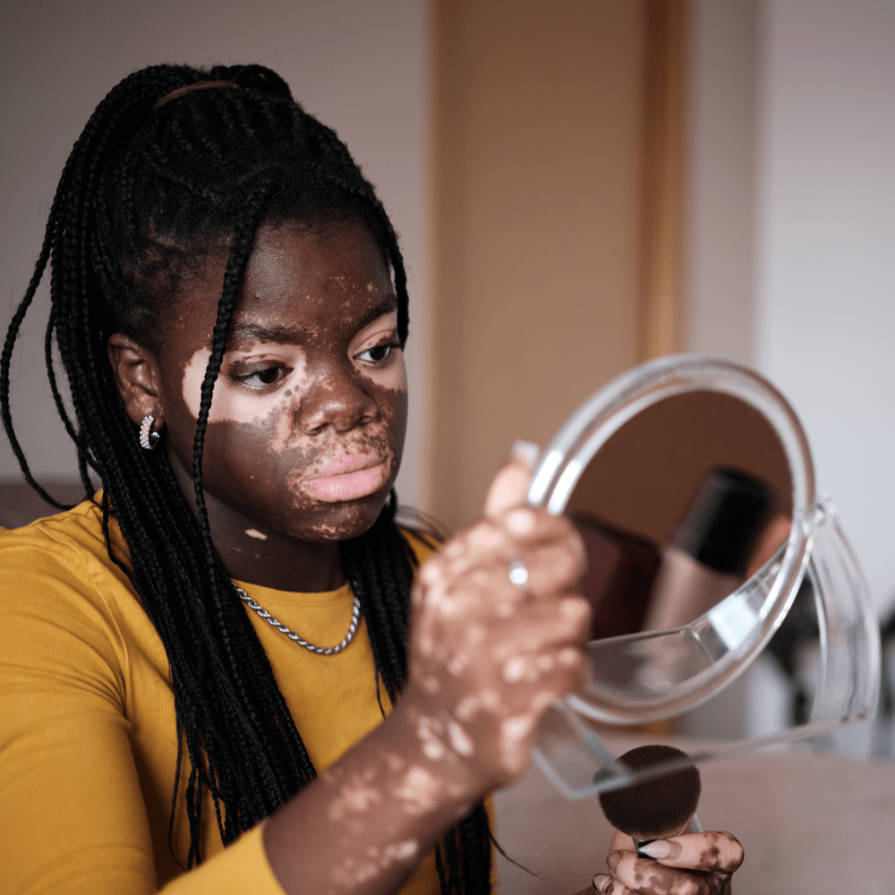 Face involvement is reflective of global perception of extent in vitiligo patients